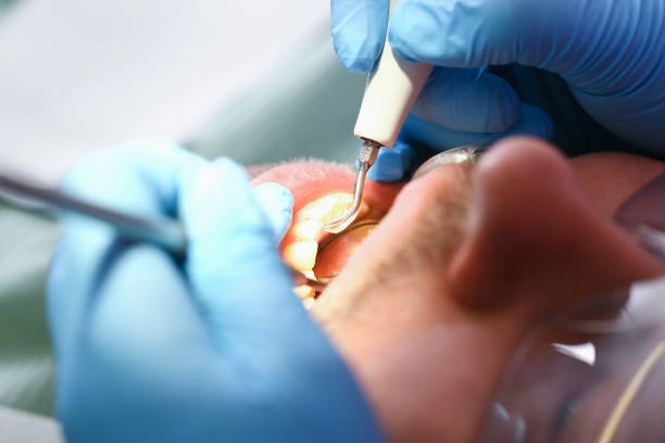 Best Emergency Wisdom Tooth Extraction in Columbus, TX